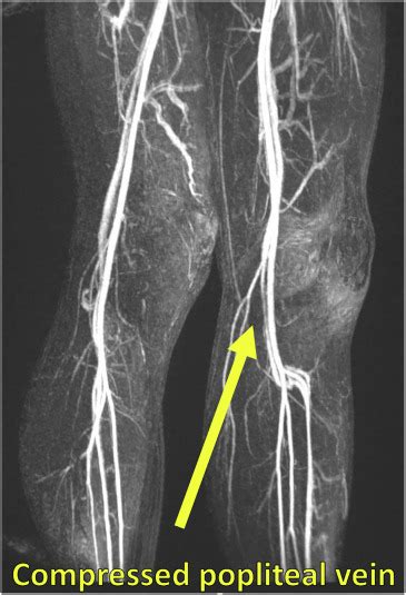 popliteal compression test|popliteal artery surgery.